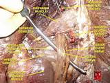 sciatic nerve and piriformis muscle